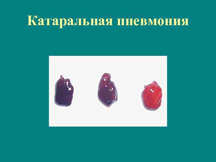 Катаральная пневмония 