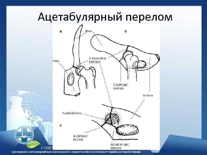 Ацетабулярный перелом 