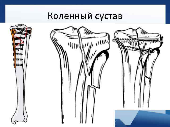 Коленный сустав 