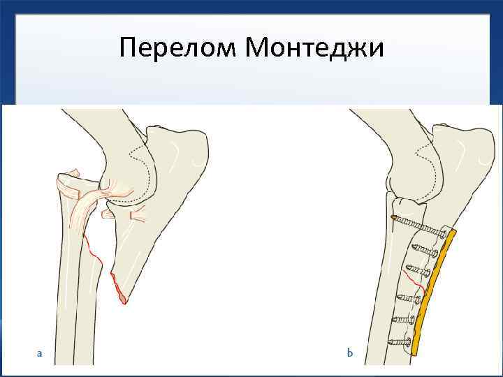 Перелом Монтеджи 