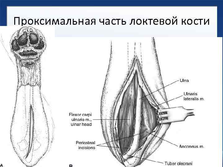 Проксимальная часть локтевой кости 