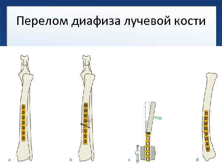 Дистальной трети диафиза. Перелом средней трети диафиза лучевой кости.