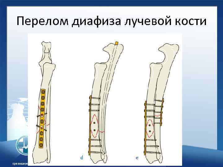 Дистальной трети диафиза