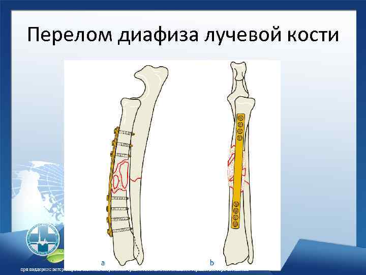 Перелом диафиза лучевой кости 