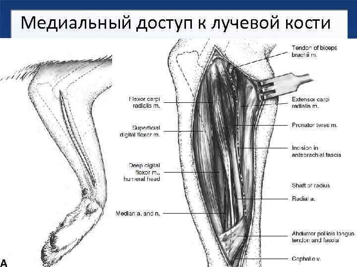 Медиальный доступ к лучевой кости 