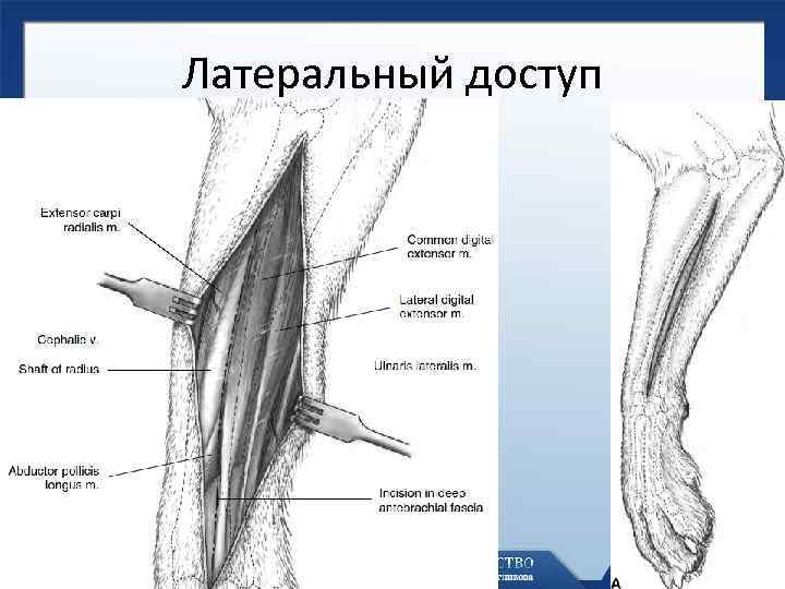 Латерально распространяющееся