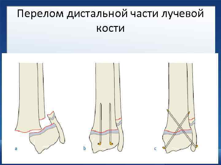Дистальный метаэпифиз лучевой кости фото. Перелом дистальной части лучевой кости. Перелом дистального отдела лучевой кости. Перелом метафиза лучевой кости. Перелом дистального метафиза лучевой кости.