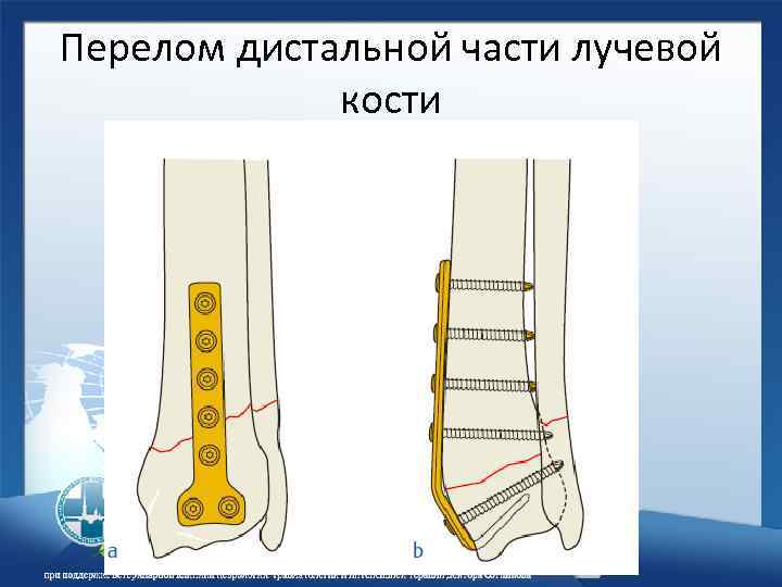 Перелом дистальной части лучевой кости 