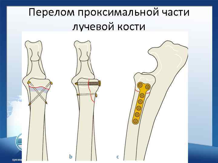 Дистальных метафизов лучевой. Перелом проксимального отдела лучевой кости. Проксимальная головка локтевой кости. Классификация АО переломов лучевой кости. Перелом дистального отдела лучевой кости.