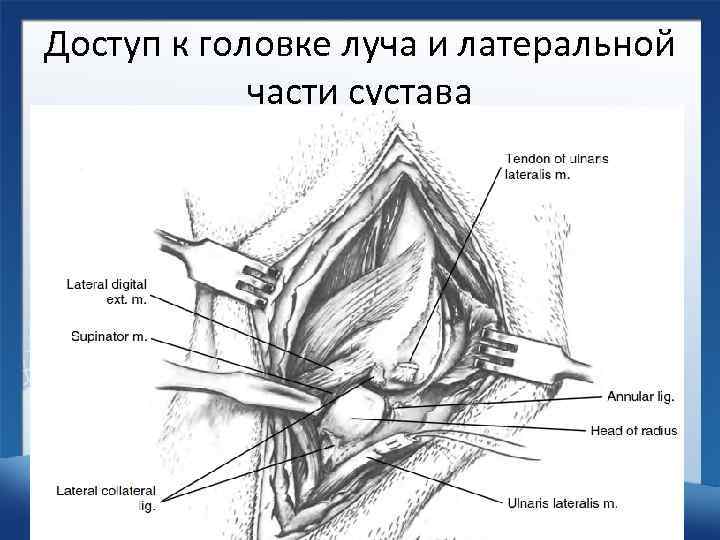 Доступ к головке луча и латеральной части сустава 