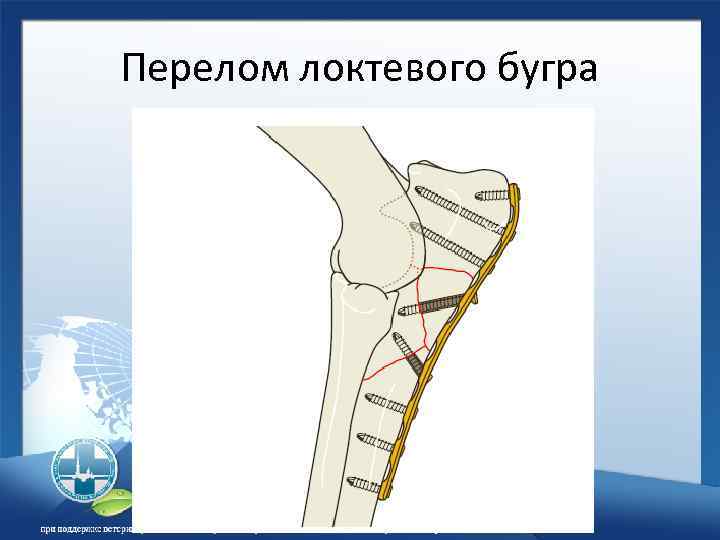 Перелом локтевого бугра 