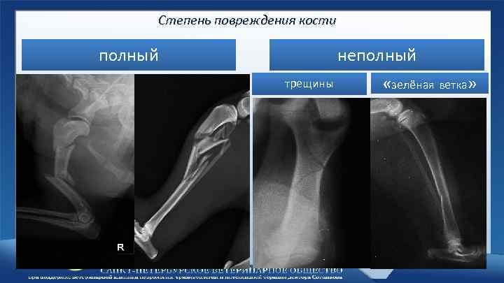 Степень повреждения кости полный неполный трещины «зелёная ветка» 