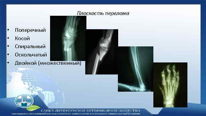 Плоскость перелома • • • Поперечный Косой Спиральный Оскольчатый Двойной (множественный) 