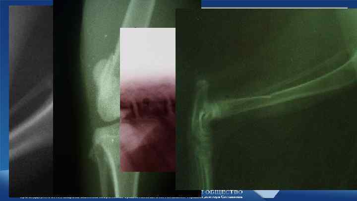 Относительное смещение костных фрагментов • • Отрывной перелом (авульсия) Вколоченный перелом Компрессионный перелом Вдавленный