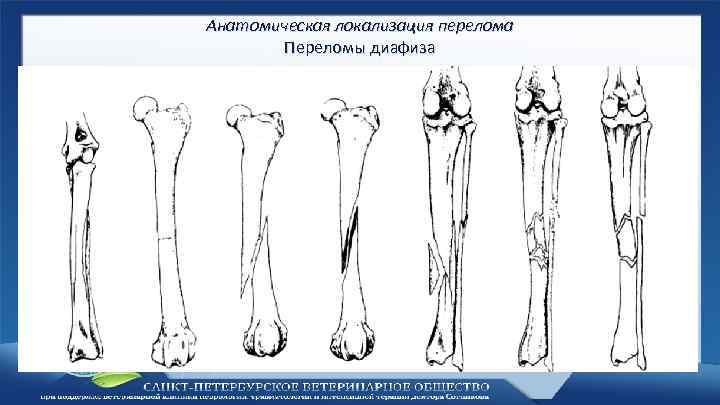 Анатомическая локализация перелома Переломы диафиза 
