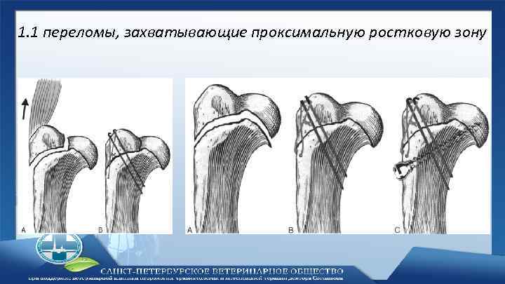 1. 1 переломы, захватывающие проксимальную ростковую зону 