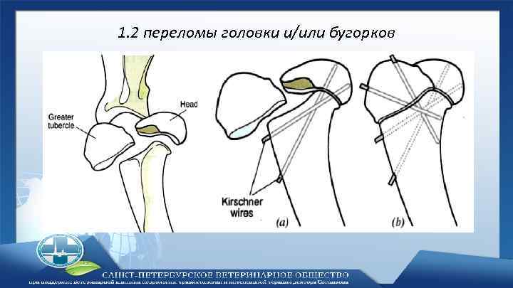 Перелом бугорка плечевой кости. Перелом медиального бугорка плечевой кости. Перелом большого бугорка плечевой кости классификация. Перелом плечевая кость анатомия. Большой бугорок плечевой кости схема.