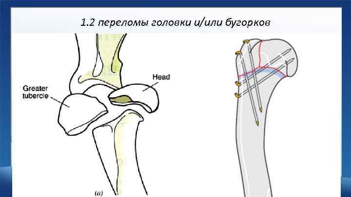 1. 2 переломы головки и/или бугорков 