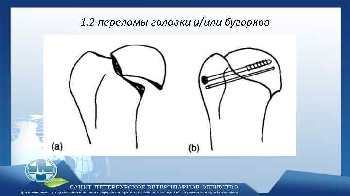 1. 2 переломы головки и/или бугорков 