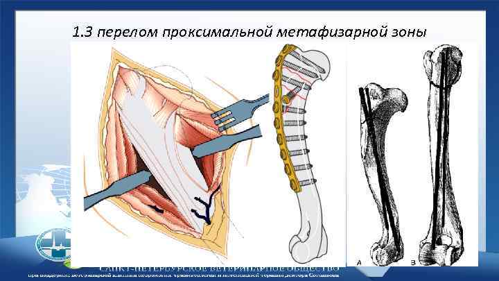 1. 3 перелом проксимальной метафизарной зоны 