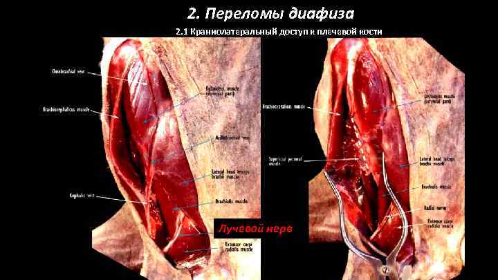 2. Переломы диафиза 2. 1 Краниолатеральный доступ к плечевой кости Лучевой нерв 