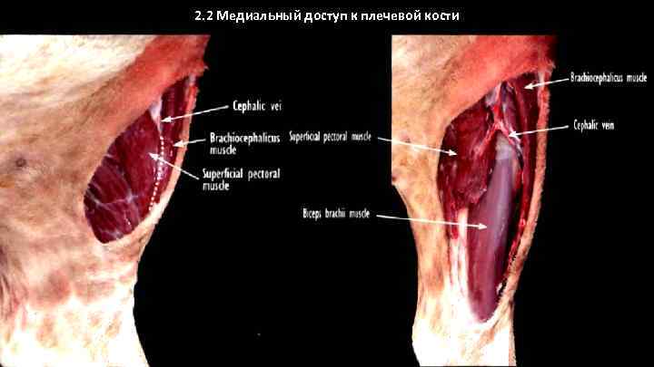 2. 2 Медиальный доступ к плечевой кости 