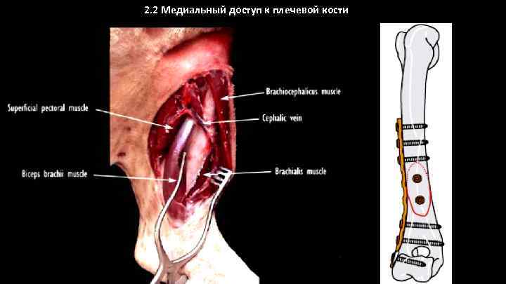 2. 2 Медиальный доступ к плечевой кости 