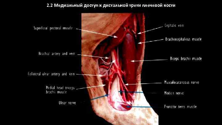 2. 2 Медиальный доступ к дистальной трети плечевой кости 