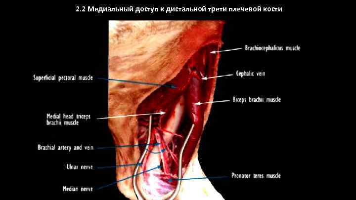 2. 2 Медиальный доступ к дистальной трети плечевой кости 