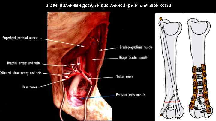 2. 2 Медиальный доступ к дистальной трети плечевой кости 