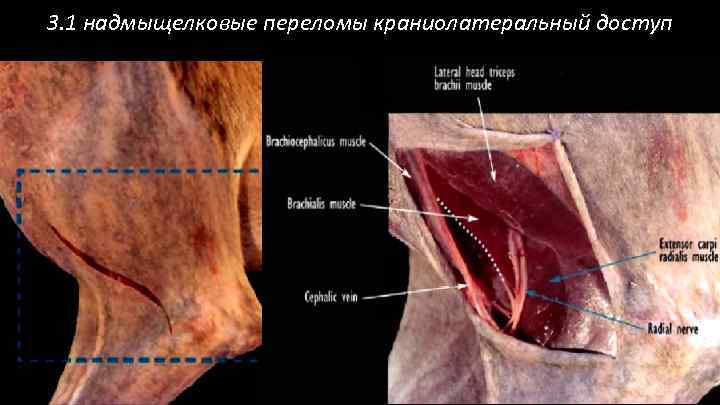 3. 1 надмыщелковые переломы краниолатеральный доступ 