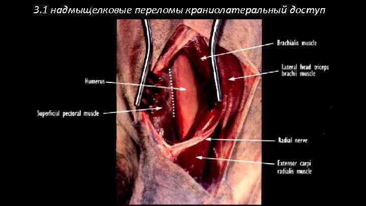 3. 1 надмыщелковые переломы краниолатеральный доступ 