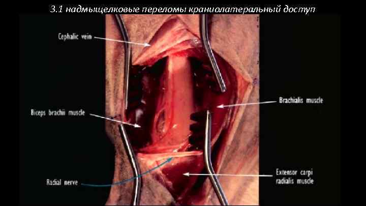 3. 1 надмыщелковые переломы краниолатеральный доступ 