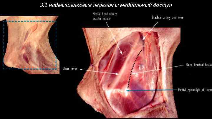 3. 1 надмыщелковые переломы медиальный доступ 