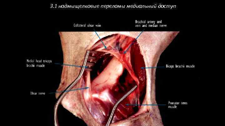 3. 1 надмыщелковые переломы медиальный доступ 