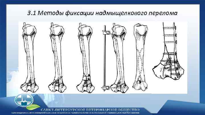 3. 1 Методы фиксации надмыщелкового перелома 