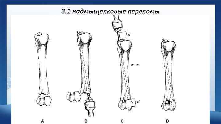 Открытый перелом плечевой кости карта вызова