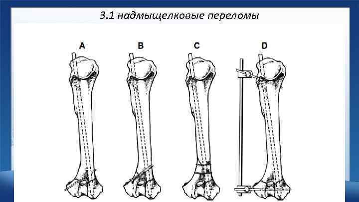 3. 1 надмыщелковые переломы 