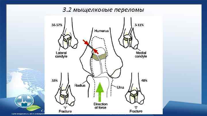 3. 2 мыщелковые переломы 56 -57% 33% 3 -11% 40% 