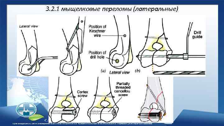 3. 2. 1 мыщелковые переломы (латеральные) 