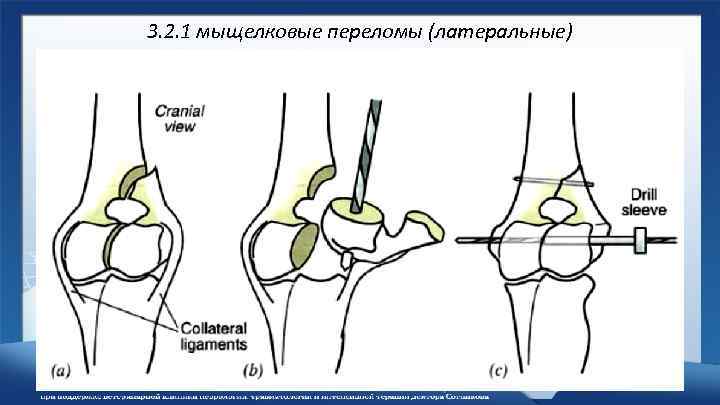 3. 2. 1 мыщелковые переломы (латеральные) 