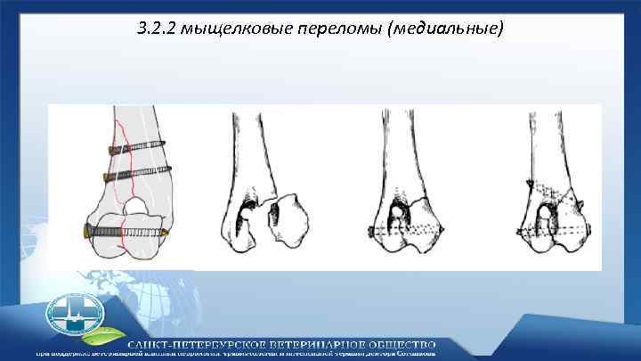 3. 2. 2 мыщелковые переломы (медиальные) 