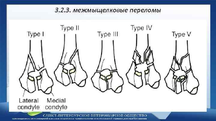 3. 2. 3. межмыщелковые переломы 