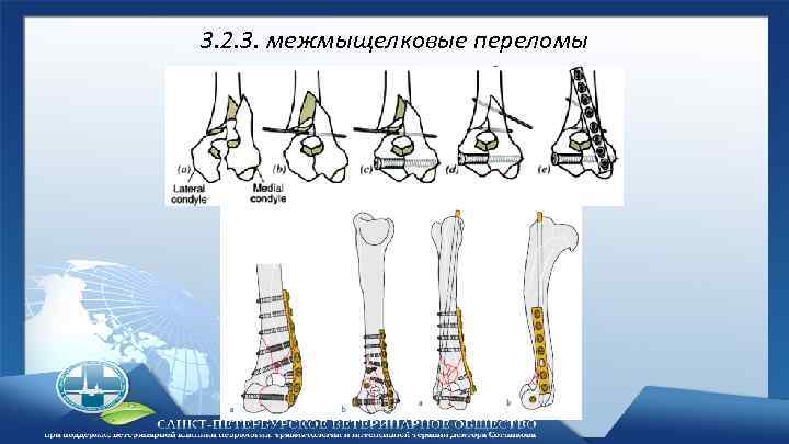 3. 2. 3. межмыщелковые переломы 