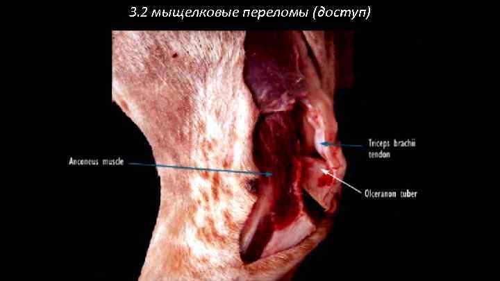 3. 2 мыщелковые переломы (доступ) 