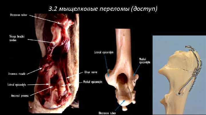 3. 2 мыщелковые переломы (доступ) 