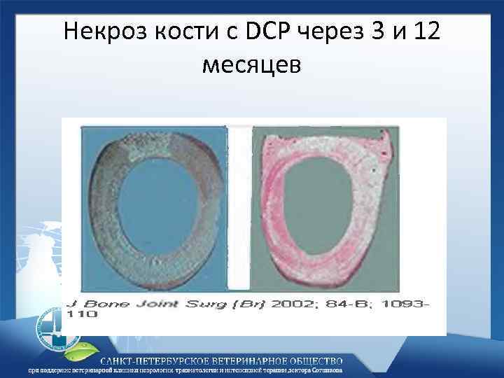 Некроз кости с DCP через 3 и 12 месяцев 