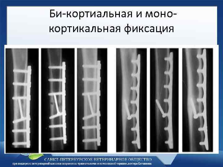 Би-кортиальная и монокортикальная фиксация 