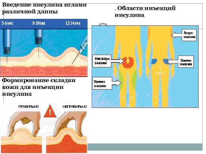 Введение инсулина иглами различной длины Формирование складки кожи для инъекции инсулина . Области инъекций