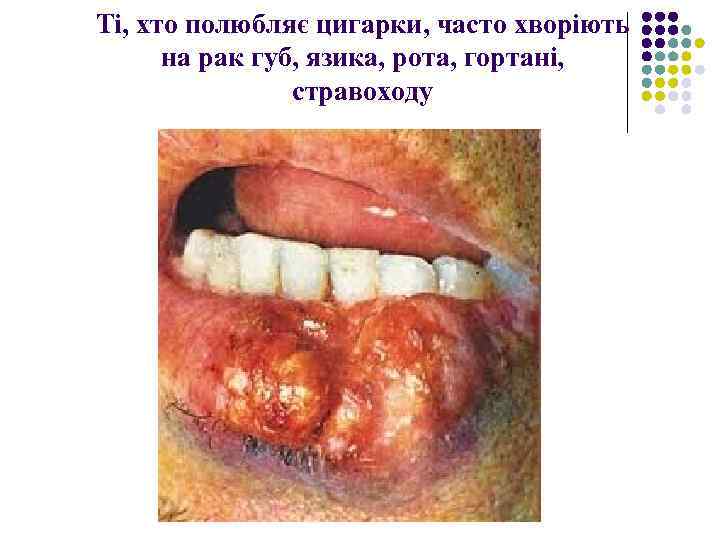 Ті, хто полюбляє цигарки, часто хворіють на рак губ, язика, рота, гортані, стравоходу 